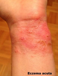 eczema acuta