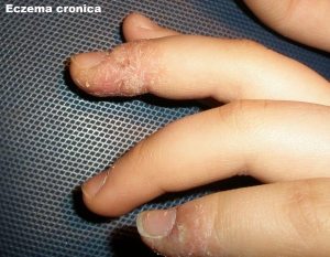 eczema cronica 2