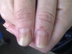 tratamentul popular al ciupercilor pe unghiile mâinilor