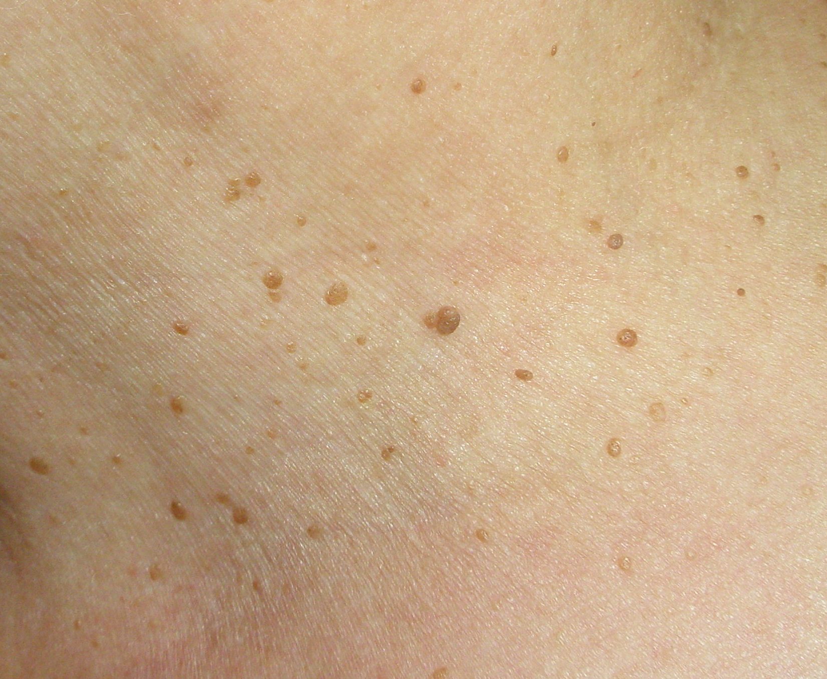 tratamentul papiloamelor pe piele